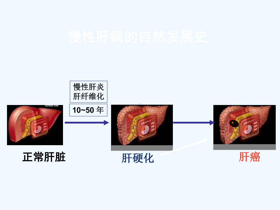 肝纤维化的无创诊断重庆医科大学附属第二医院张大志课件.ppt_第3页