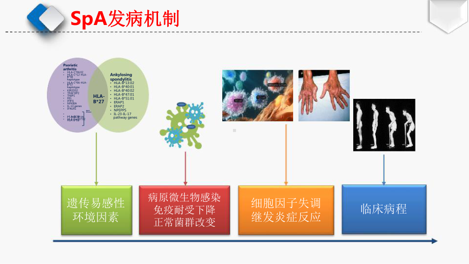 脊柱关节炎MRI读片技巧(骶髂关节篇)课件.pptx_第3页