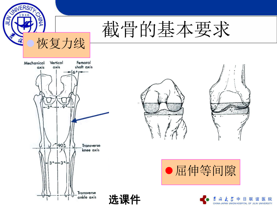 全膝关节置换的截骨原则课件.ppt_第3页