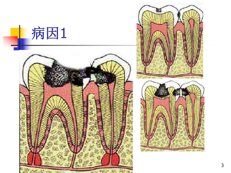 牙髓疾病及治疗方法课件.ppt_第3页