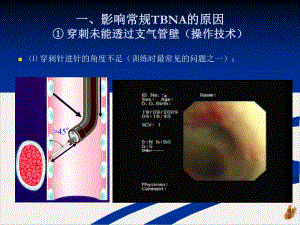 经支气管针吸活检技术操作事项培训课程课件.pptx