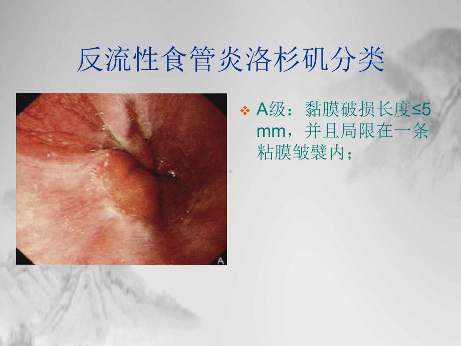 消化道疾患内镜分级诊断课件.pptx_第1页