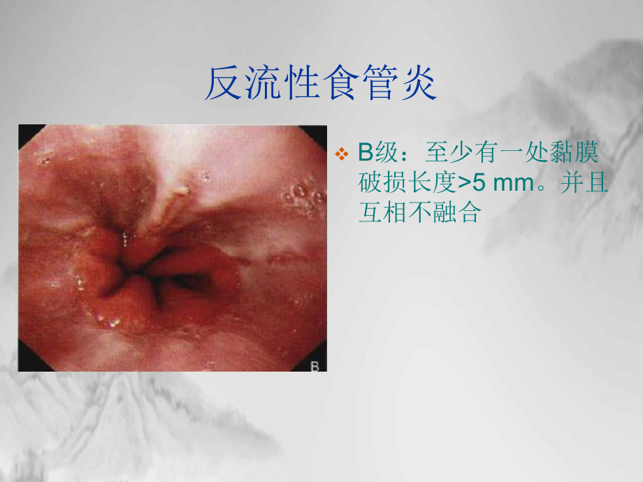 消化道疾患内镜分级诊断课件.pptx_第2页