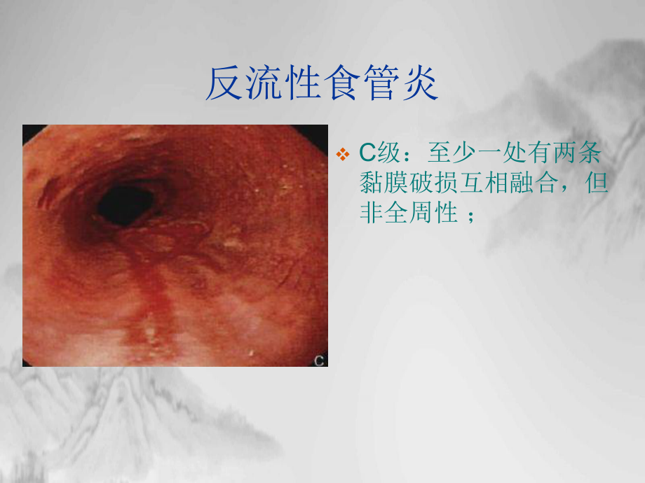 消化道疾患内镜分级诊断课件.pptx_第3页