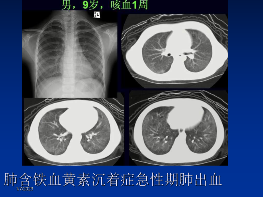 胸部少见疾病影像诊断课件整理-002.ppt_第1页