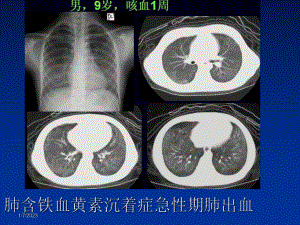 胸部少见疾病影像诊断课件整理-002.ppt