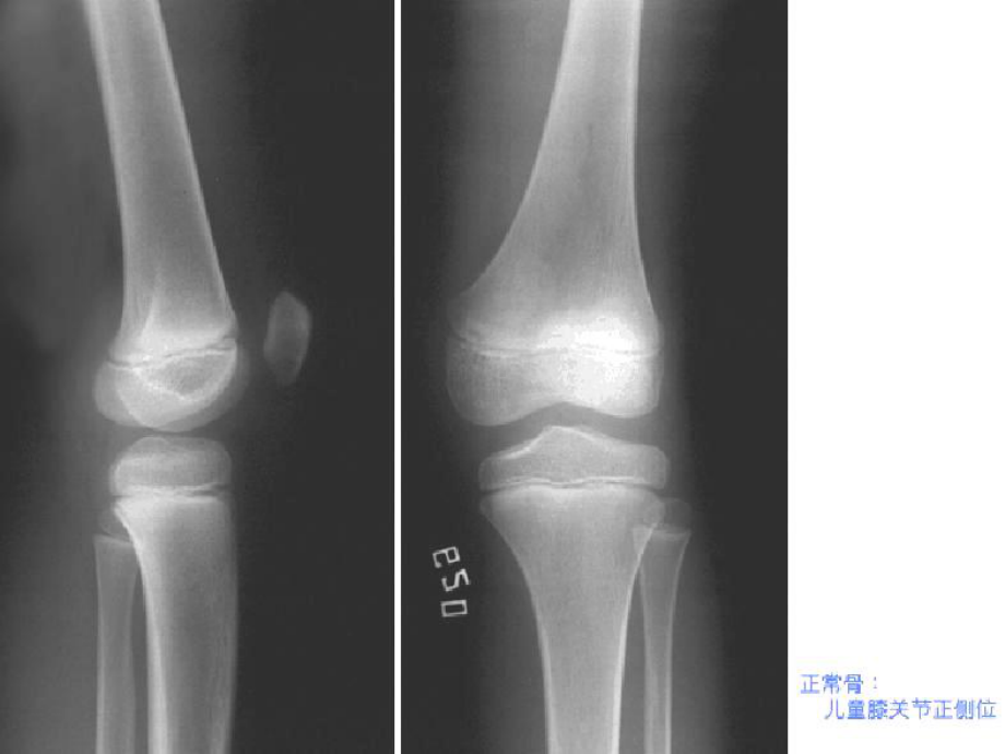 骨与关节基本病理表现教学课件.pptx_第2页