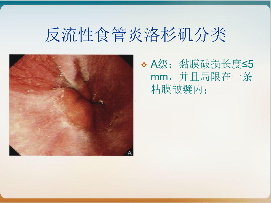 消化道疾患内镜分级诊断培训经典课件整理.ppt_第2页