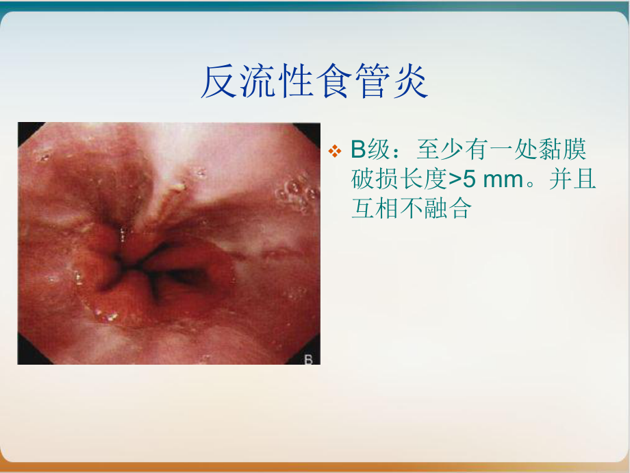 消化道疾患内镜分级诊断培训经典课件整理.ppt_第3页