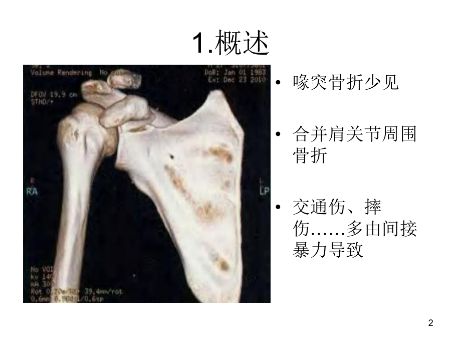 肩胛骨-喙突骨折的治疗课件.ppt_第2页