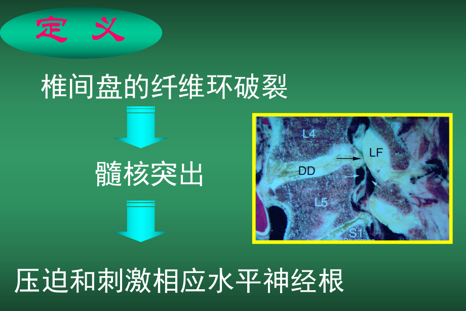 直腿抬高少脊髓造影单节段N根袖中断多节段硬膜囊压迫课件.ppt_第2页