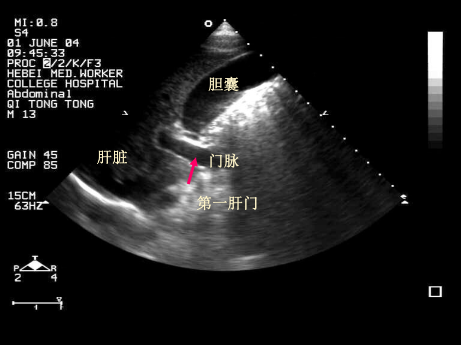 肝脏占位性病变课件.pptx_第3页