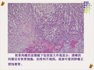 软骨肉瘤的病理及影像学表现课件整理.pptx