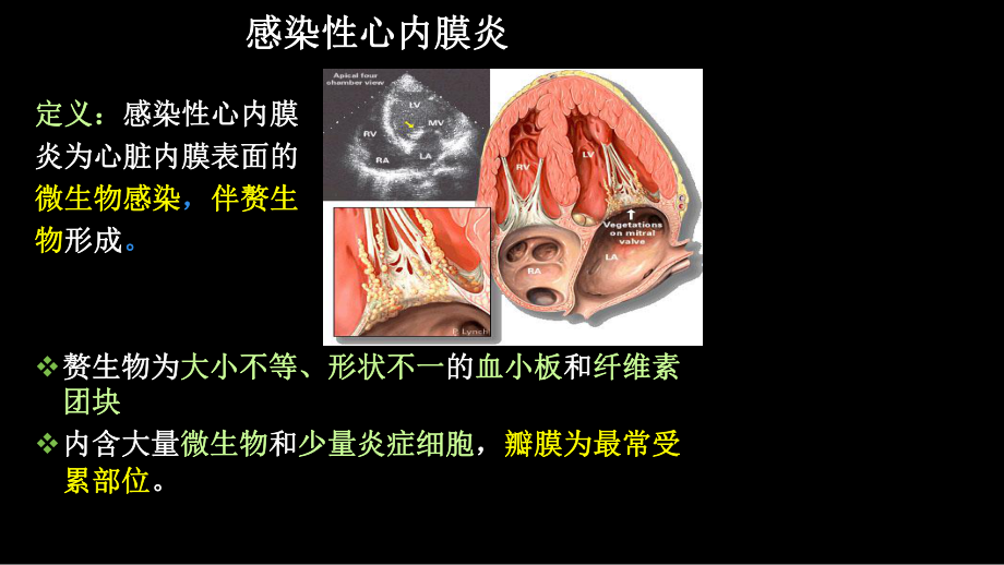 第七节-感染性心内膜炎病人的护理课件.ppt_第3页