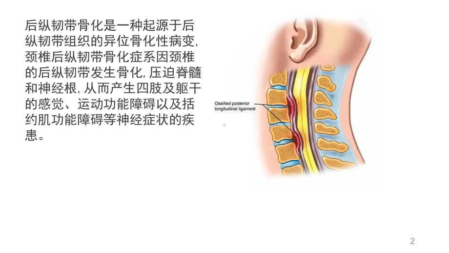 颈椎后纵韧带骨化症课件.ppt_第2页