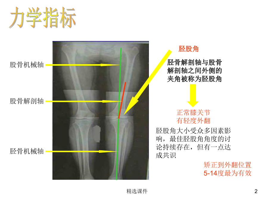 漂浮体位治疗胫骨平台骨折课件.ppt_第2页