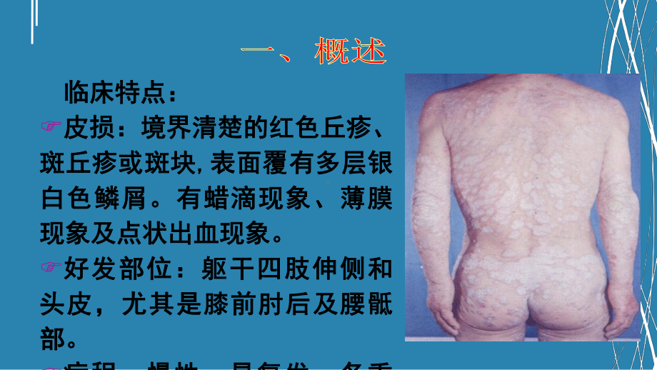 银屑病的膏方应用课件.ppt_第3页