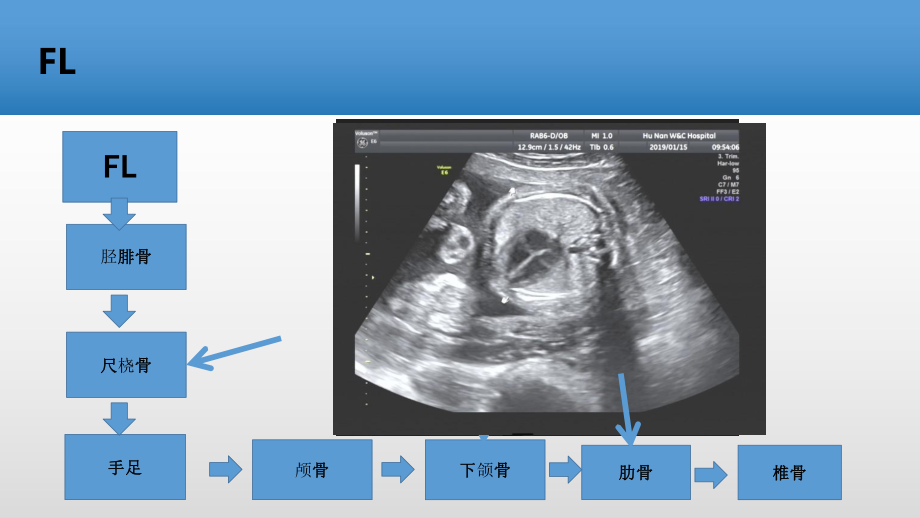 骨骼畸形产前超声筛查诊断课件.pptx_第3页