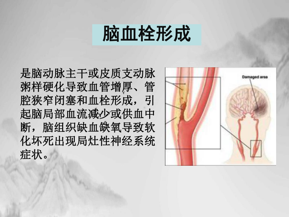 神经病学脑血管病课件.pptx_第1页