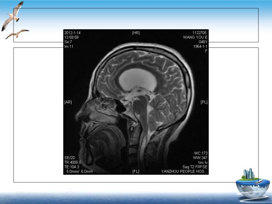 脑疝的影像学表现优质课件.ppt_第3页