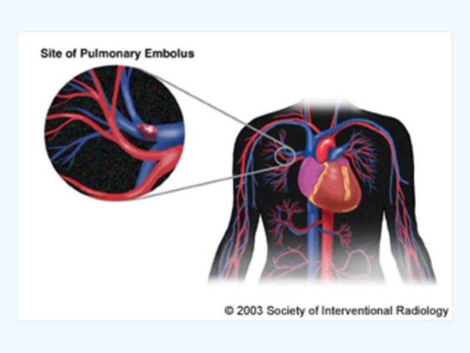 肺栓塞护理查房-课件.ppt_第3页