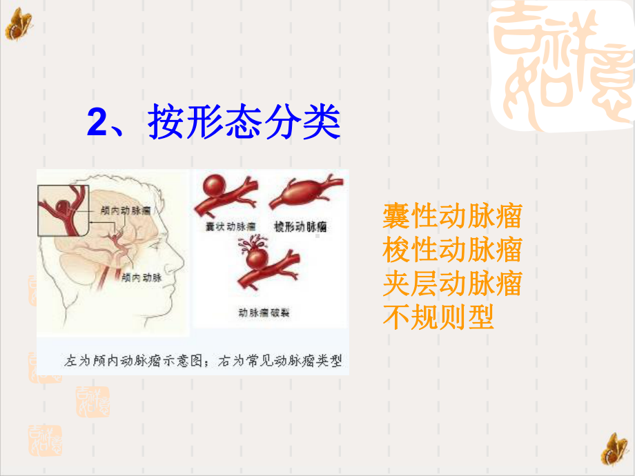 颅内动脉瘤夹闭术课件1.pptx_第3页