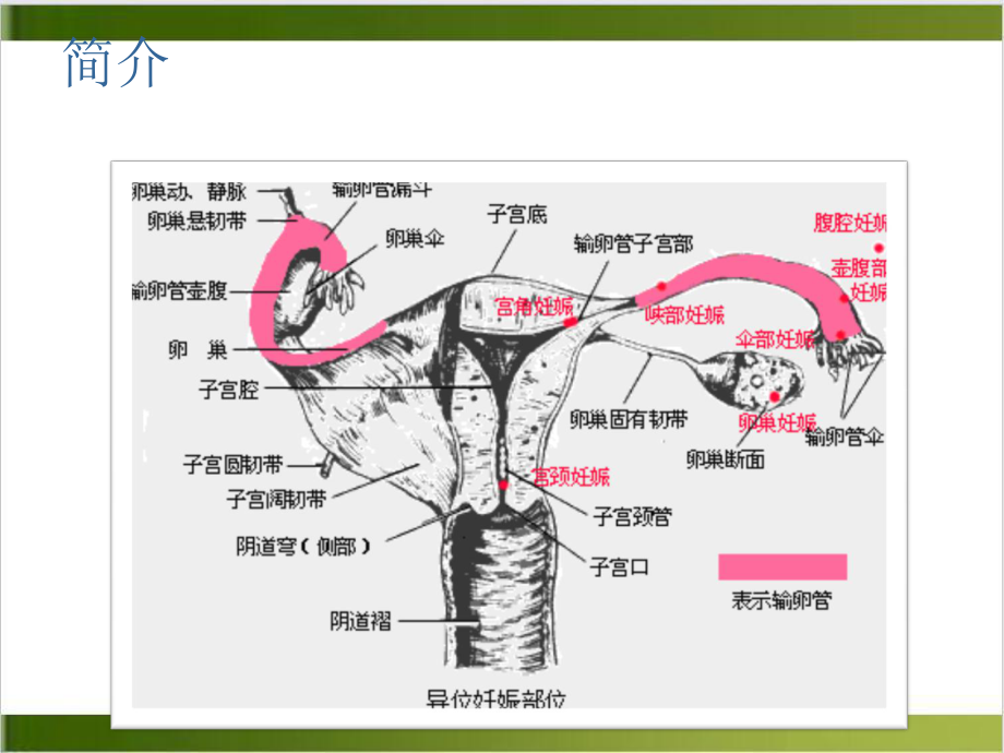 输卵管异位妊娠课件.pptx_第3页