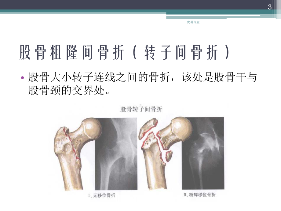 骨骼概述及骨科常见疾病(沐风教学)课件.pptx_第3页