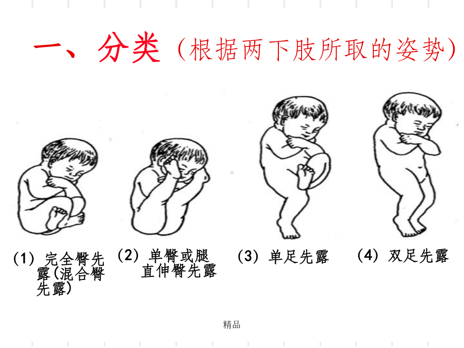 臀位分娩[1]课件.ppt_第2页