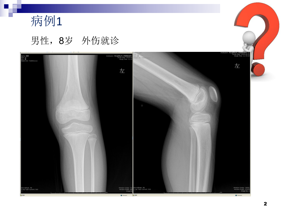 非骨化纤维瘤影像诊断课件.ppt_第2页