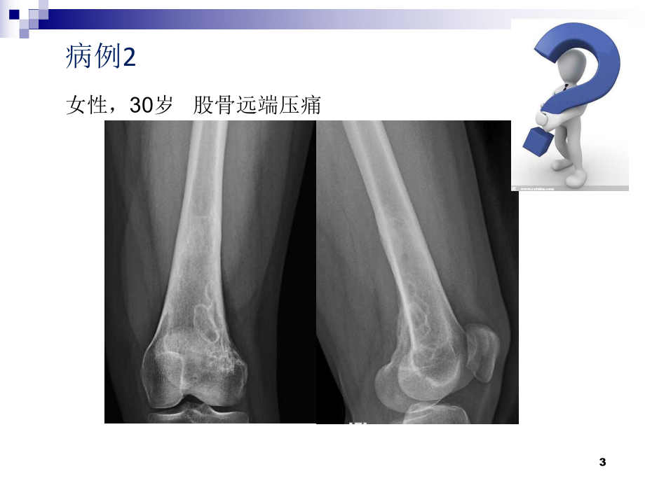 非骨化纤维瘤影像诊断课件.ppt_第3页