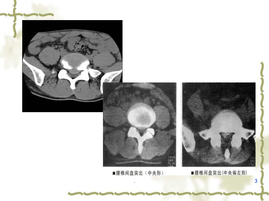 腰椎转移瘤误诊课件.ppt_第3页