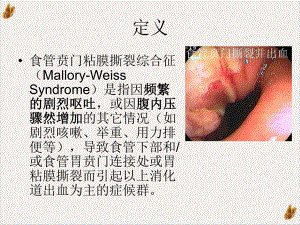 食管贲门粘膜撕裂综合征-课件.pptx