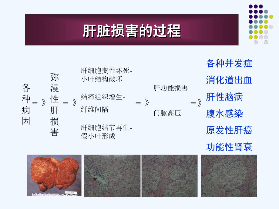 特利加压素对出血腹水与肝肾综合征治疗课件.ppt_第3页