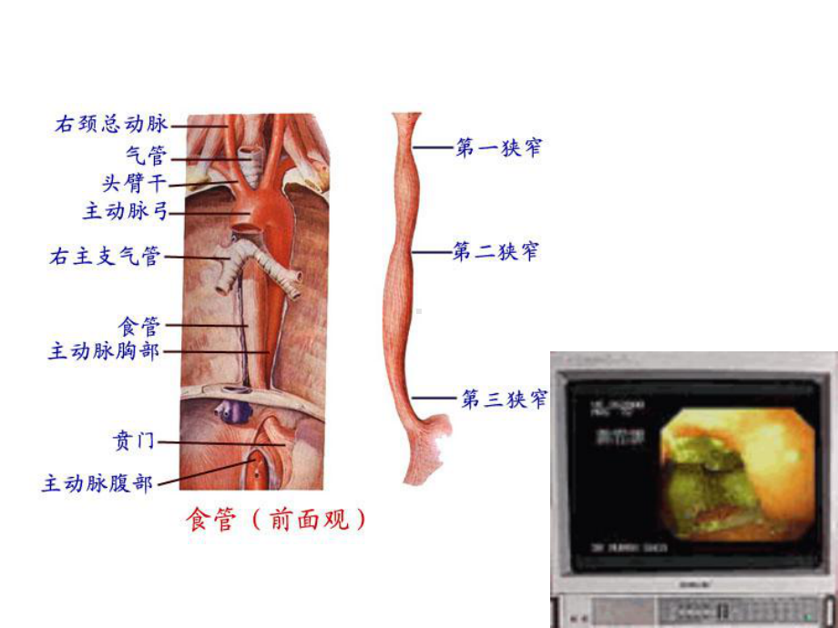 食管癌讲稿详解课件.ppt_第3页