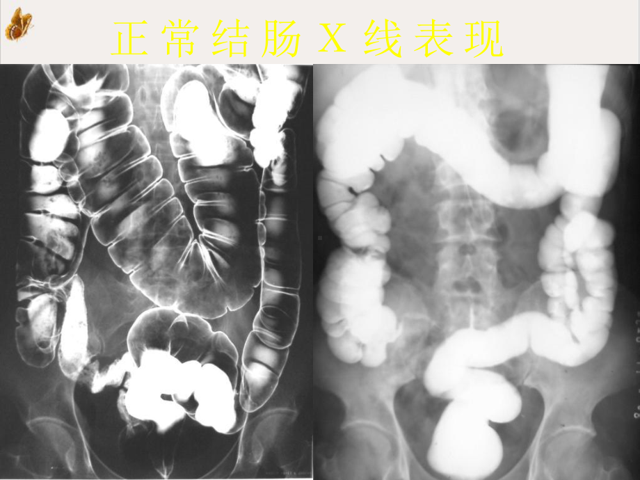 结直肠肿瘤的影像诊断课件.pptx_第1页