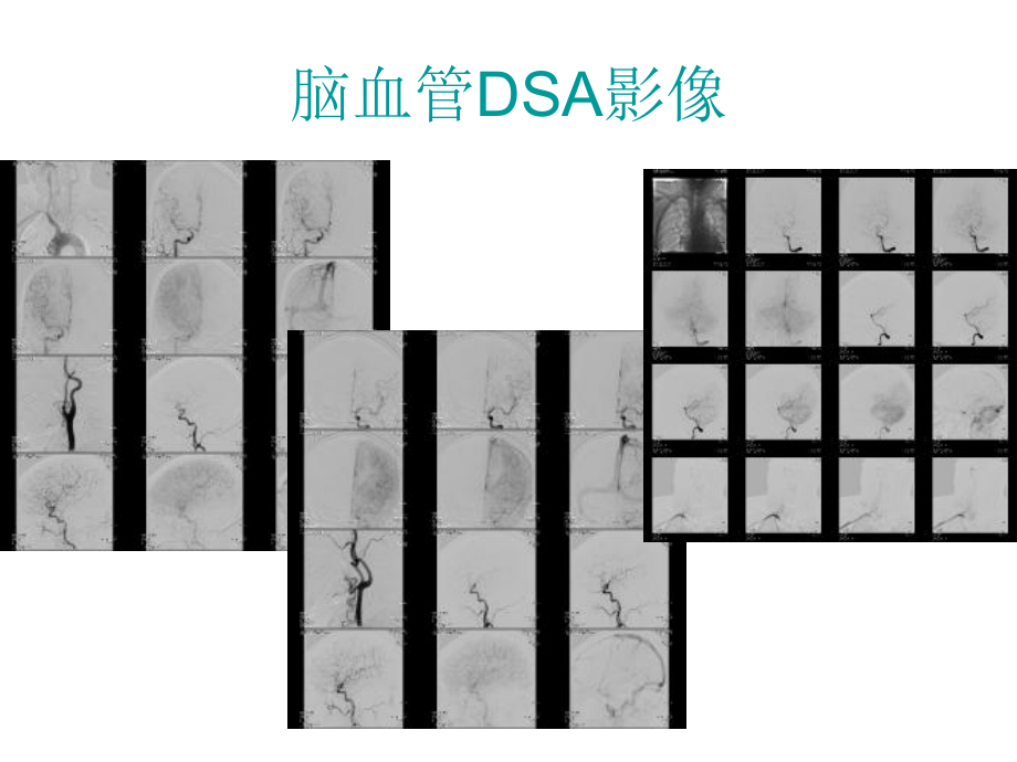 脑血管DSA影像表现课件.ppt_第2页