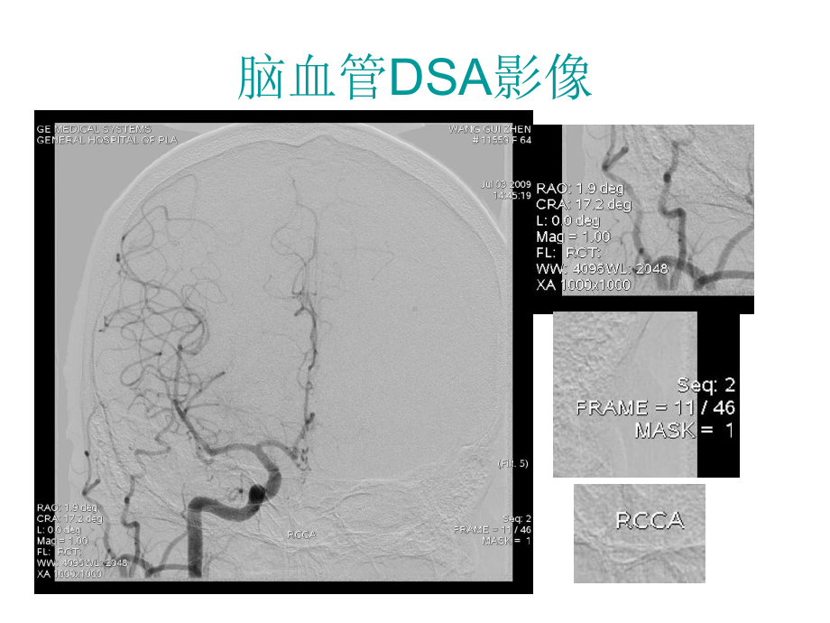 脑血管DSA影像表现课件.ppt_第3页