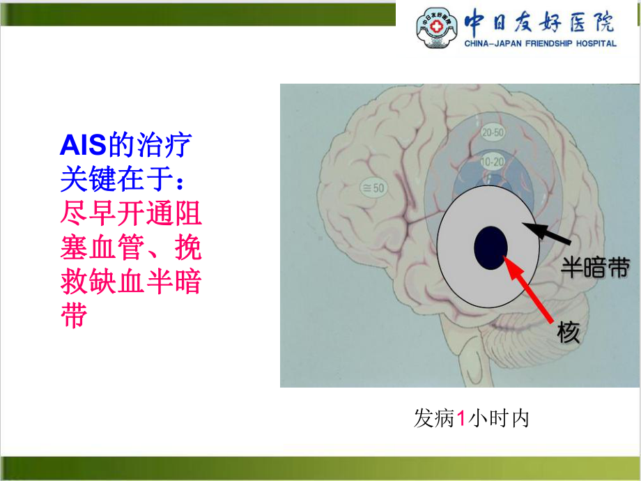 静脉溶栓的护理课件.pptx_第2页