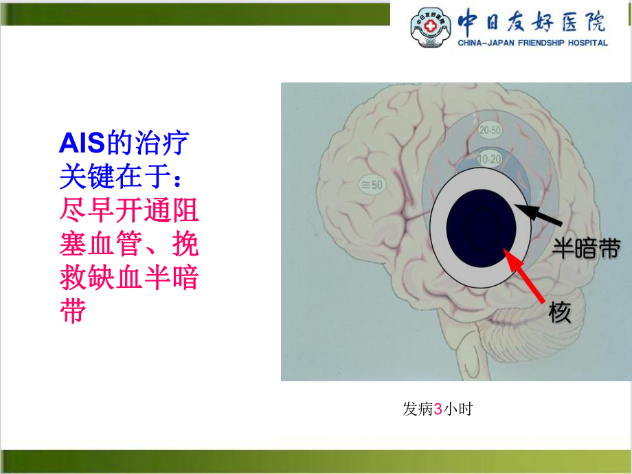 静脉溶栓的护理课件.pptx_第3页