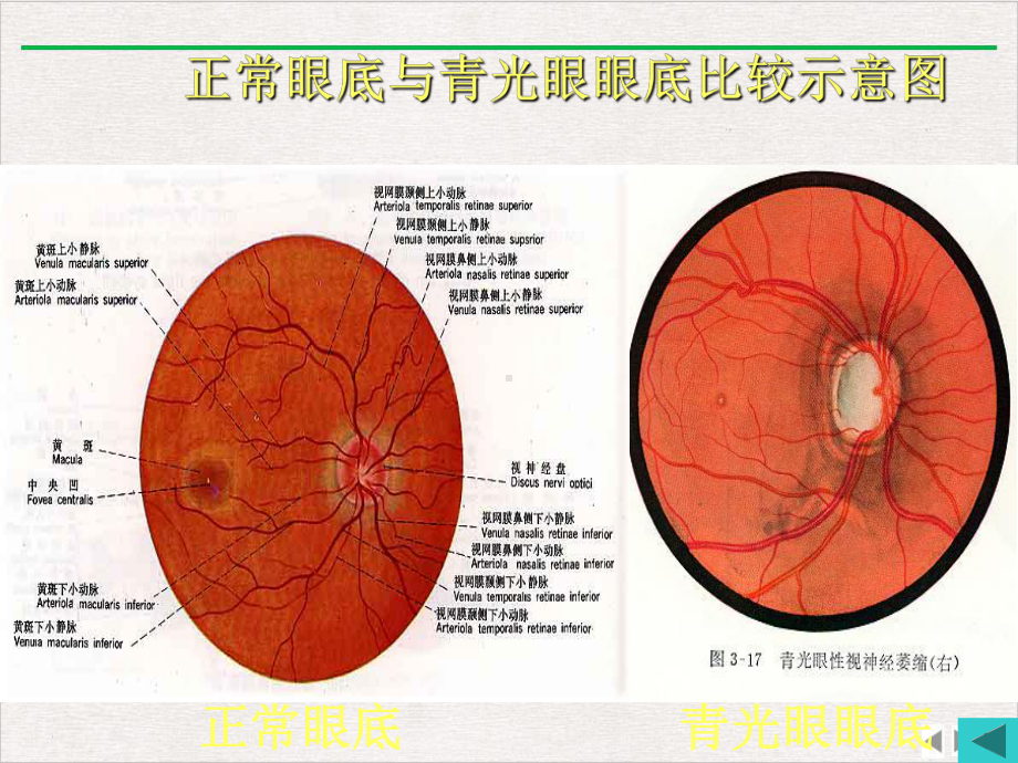 青光眼病人的护理精选课件.pptx_第3页