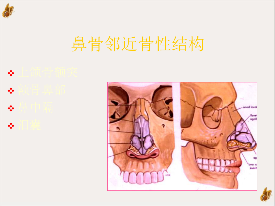 鼻骨骨折影像学诊断课件.pptx_第2页