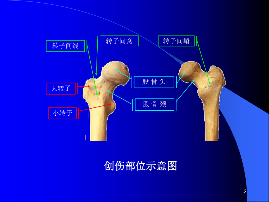 股骨转子间骨折课件整理.ppt_第3页