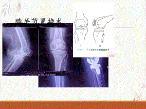 髋膝关节置换适应症和并发症课件.pptx