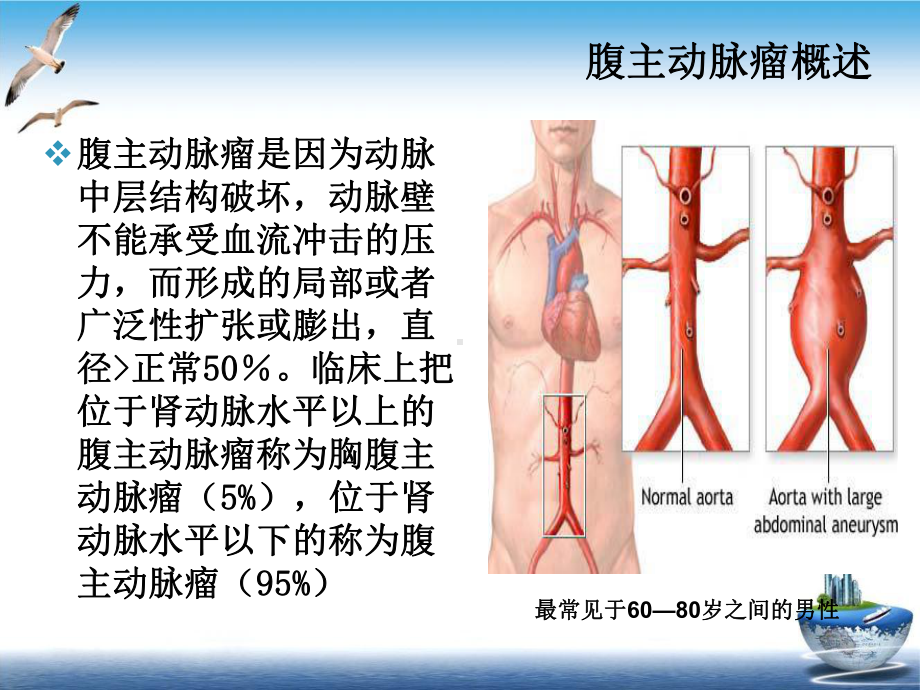 腹主动脉瘤护理查房精选课件.ppt_第3页