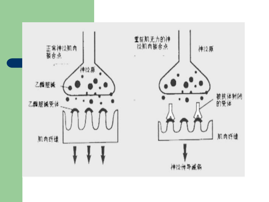 重症肌无力的临床表现及诊断课件.ppt_第3页