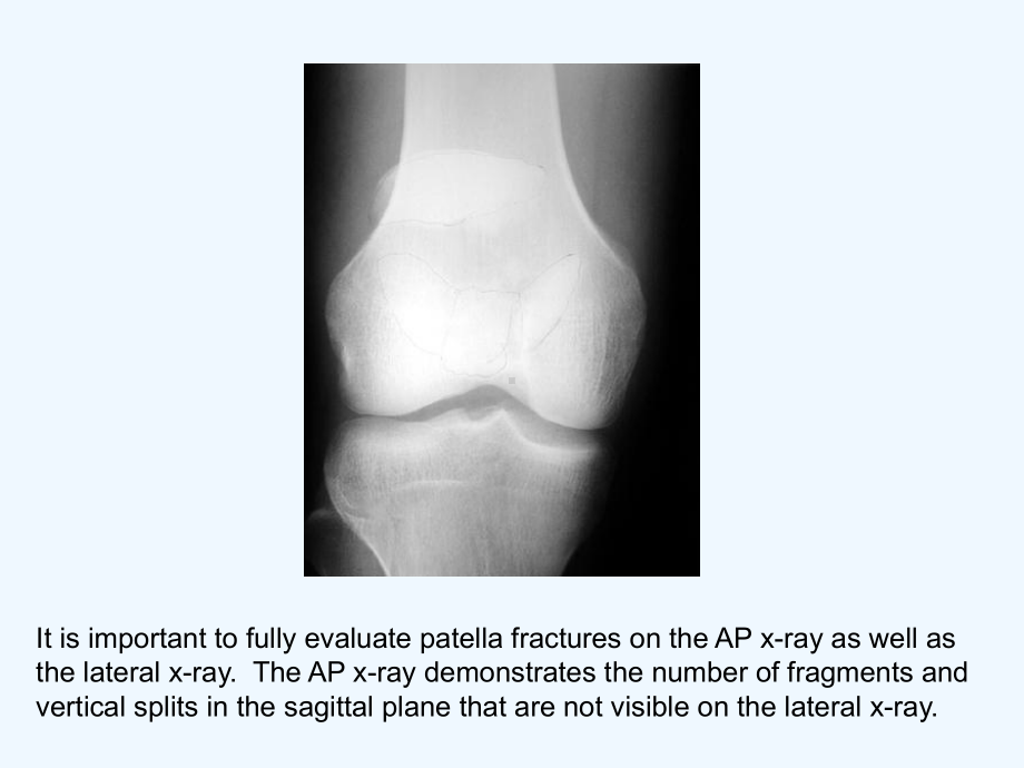 髌骨骨折(英文版)-课件.ppt_第2页