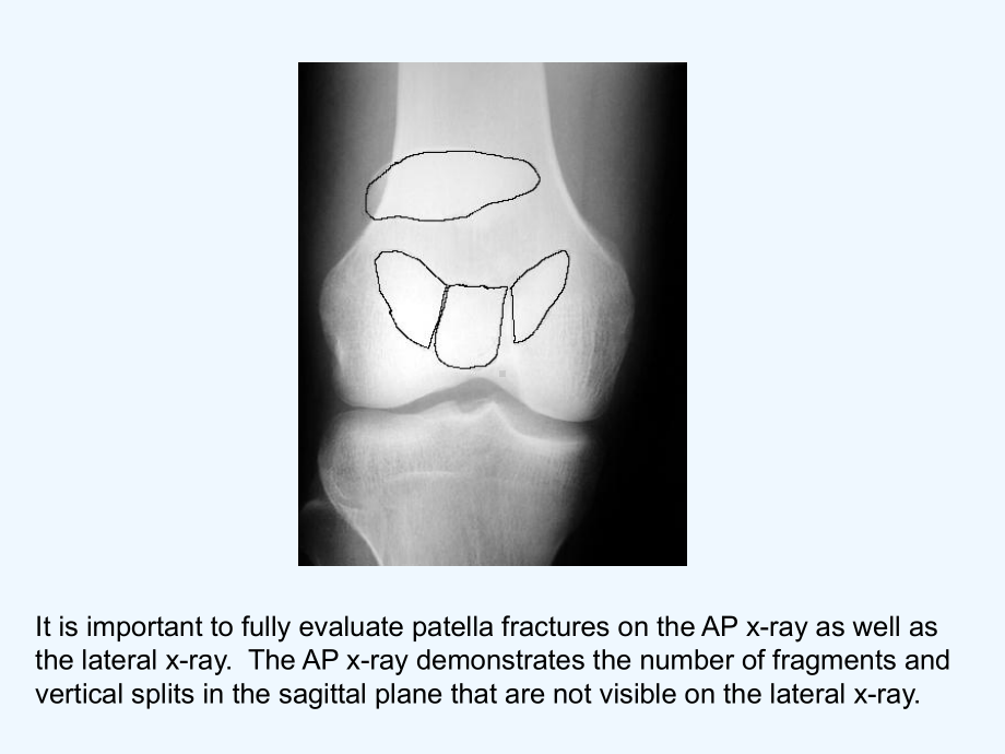 髌骨骨折(英文版)-课件.ppt_第3页