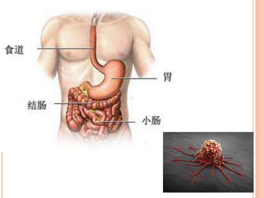 消化道肿瘤的合理诊疗与预防保健课件.pptx_第2页