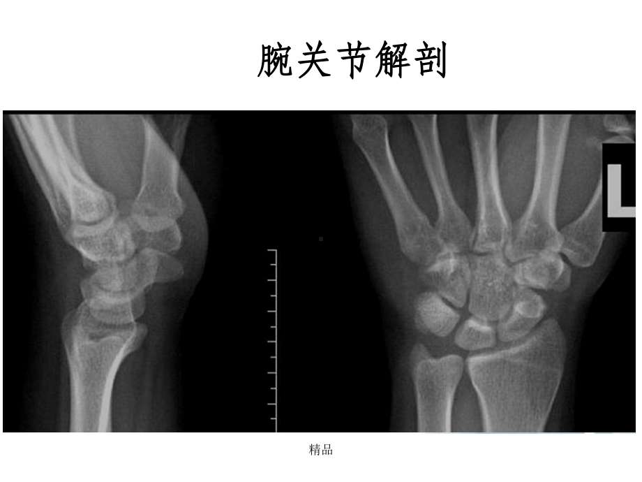 腕关节X线解剖及常见骨折诊断课件.ppt_第3页